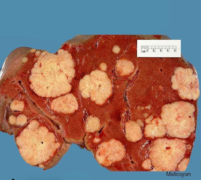 Liver metastasis