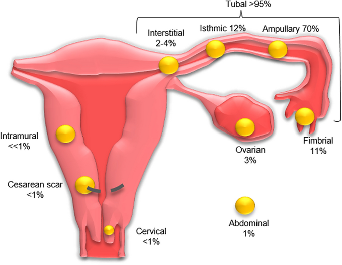 Ectopic Pregnancy- Tubes are not the only sites!