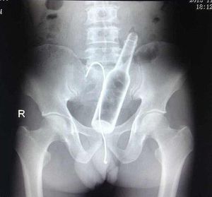 sex toy stuck in vagina Can a sex toy get stuck inside me? — Milstein main image 1