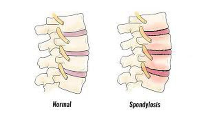 Symptoms of spondylosis
