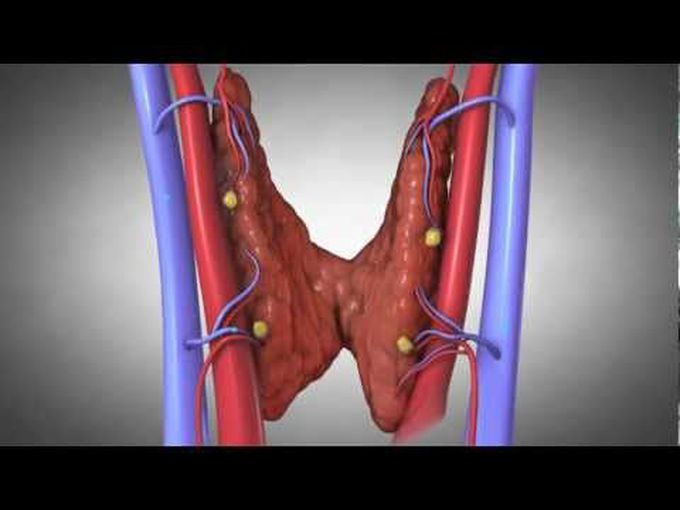 Hyperparathyroidism- animation