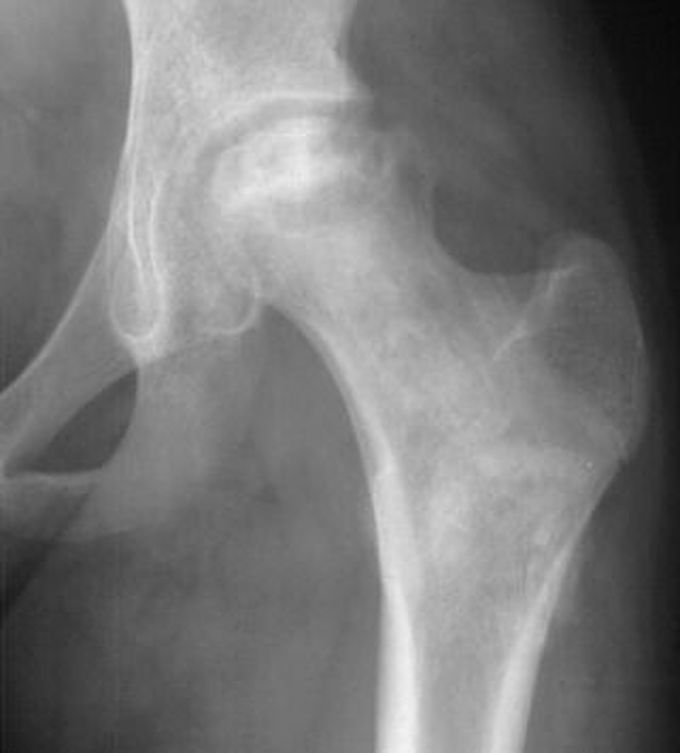 Case of Hip Avascular Necrosis