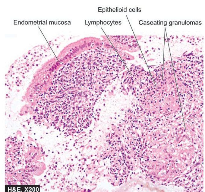 Tuberculous endometritis.