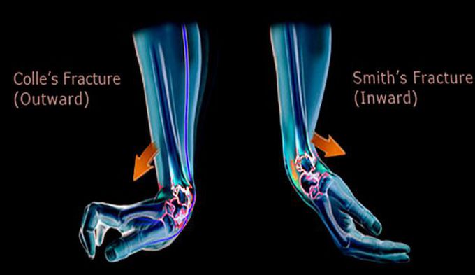 Colle's Fracture vs Smith's Fracture