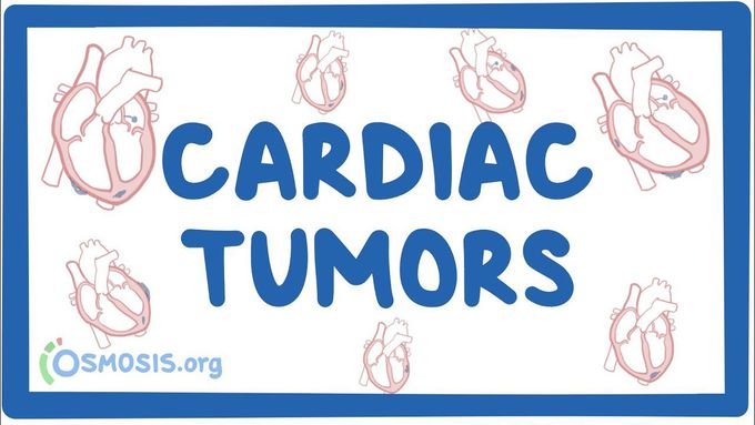 Cardiac tumors (Myxoma, Rhabdomyoma) - causes, symptoms, diagnosis, treatment, pathology
