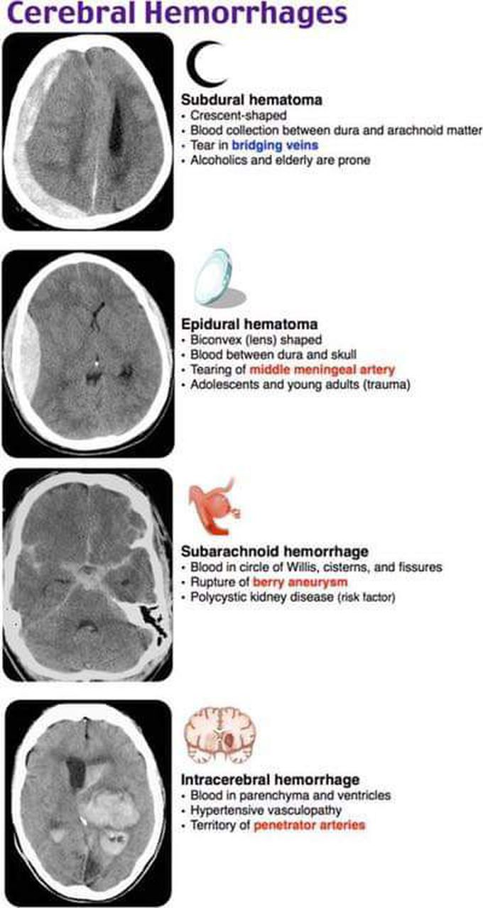 Cerebral Hemorrhage - MEDizzy