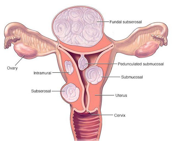 Menorrhagia