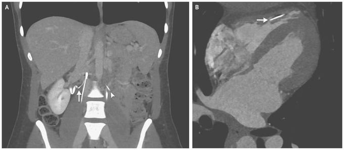 Embolization of Struts from an Inferior Vena Cava Filter