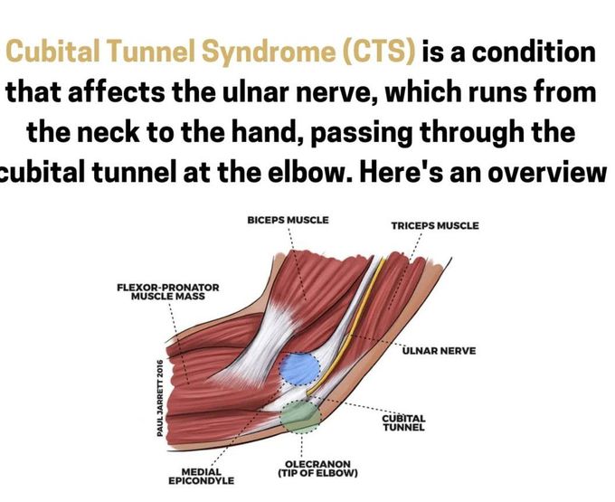 Cubital Tunnel Syndrome