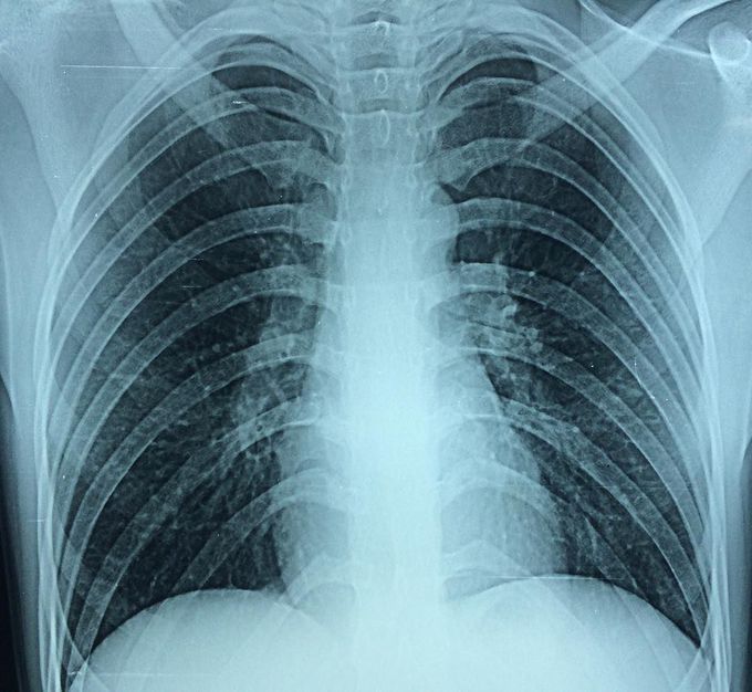 What seems to be the problem on this CXR ?