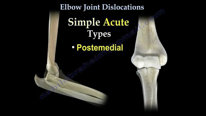 Elbow Dislocations - Everything You Need To Know - Dr. Nabil Ebraheim