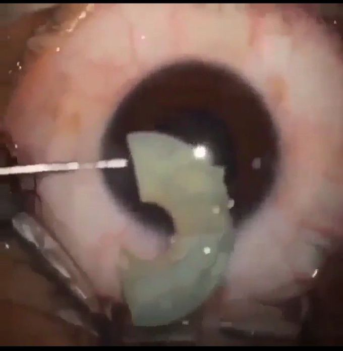 Removal of an Iris implant!