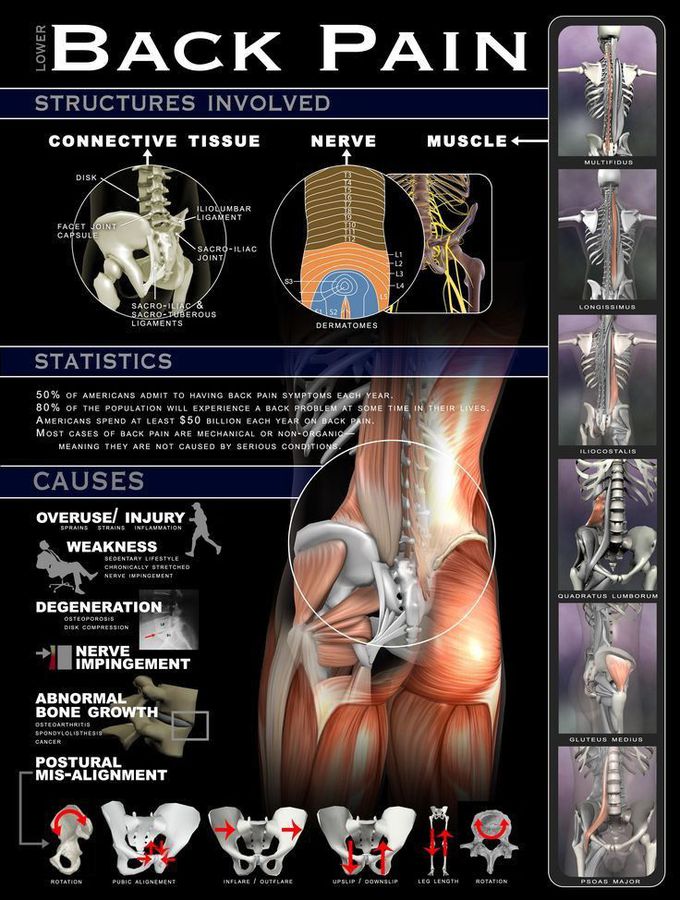 Causes of back pain