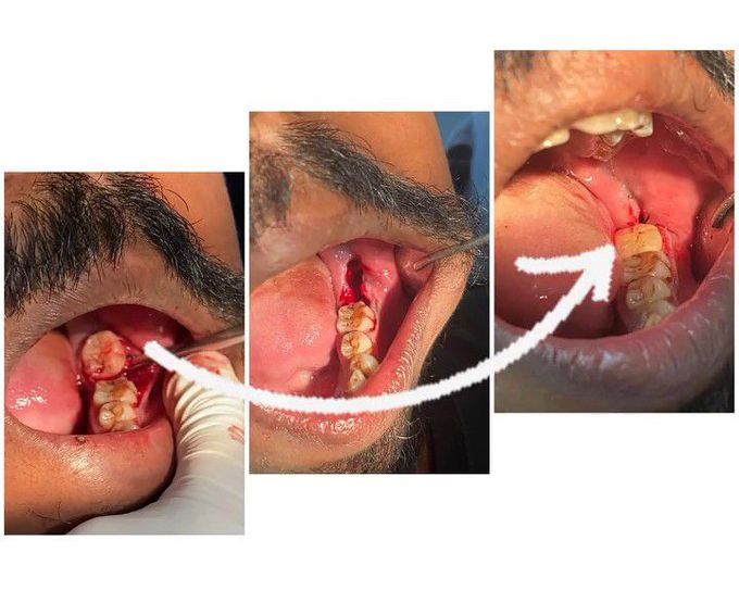 Reimplantation of 3rd molar