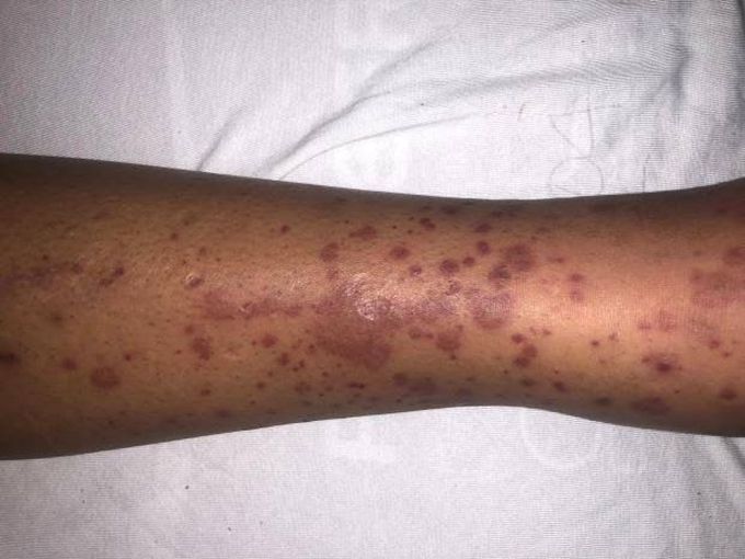 Thrombotic Thrombocytopenic Purpura