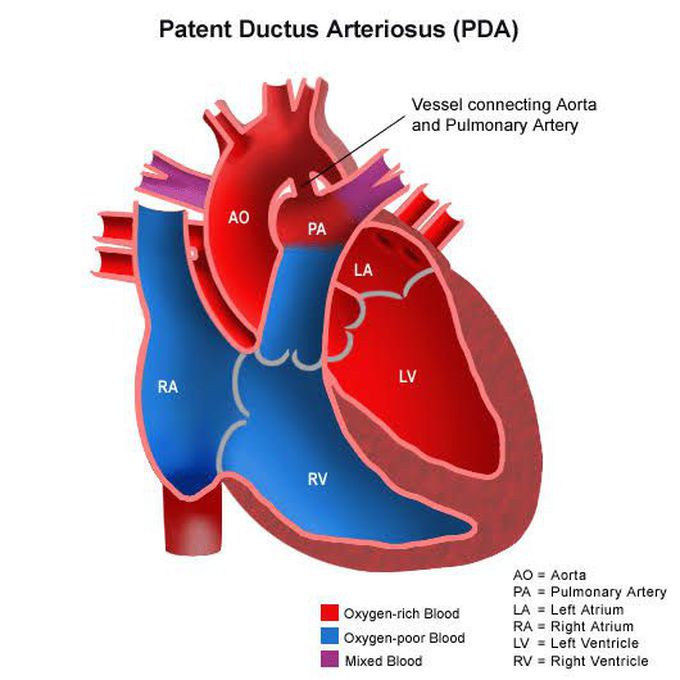 Patent Ductus Arteriosus- Treatment