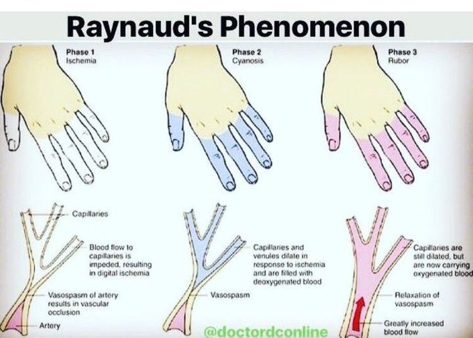 Raynaud's