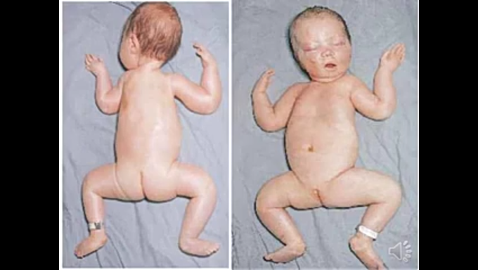 Floppy Infant