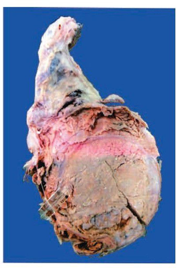 Immature teratoma testis.