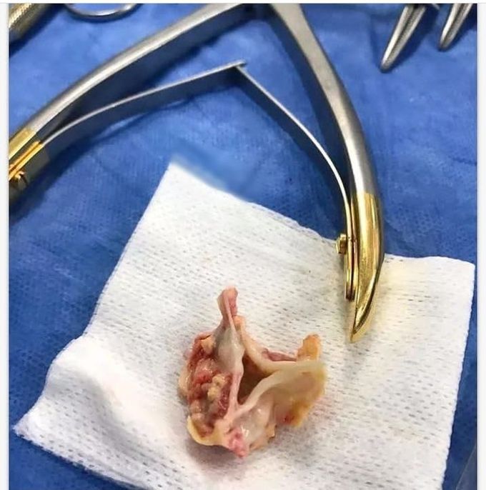 Calcified aortic valve