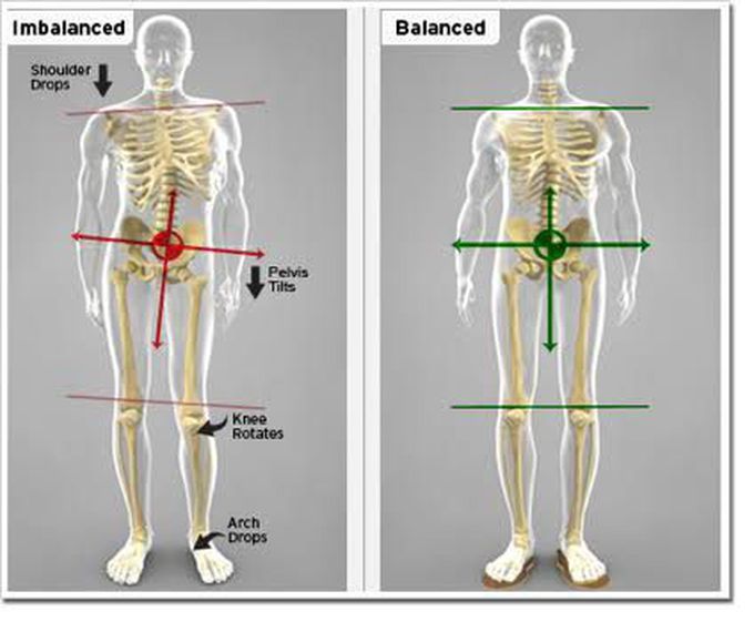 Short leg syndrome