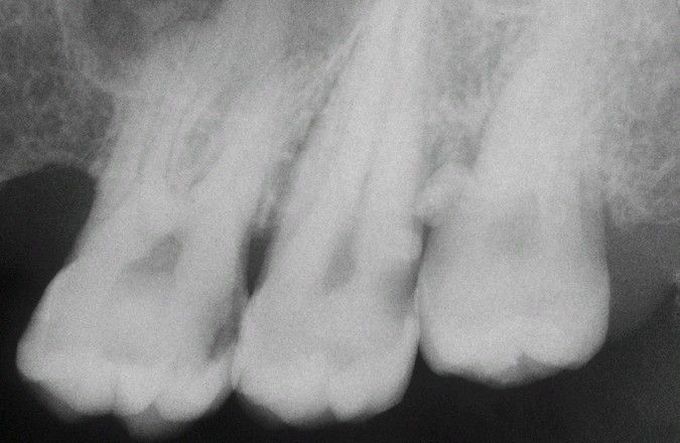 Enamel pearl radiograph