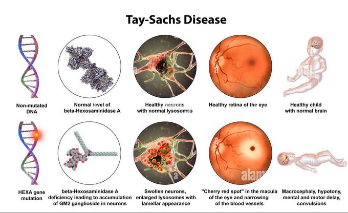 Tay-Sachs disease