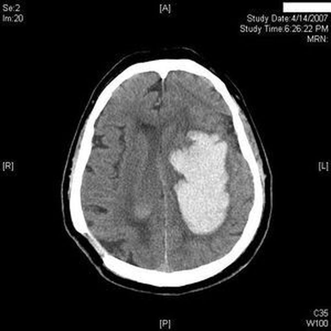 Can You Identify This Hemotoma