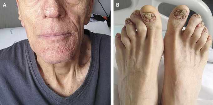 Tuberous sclerosis