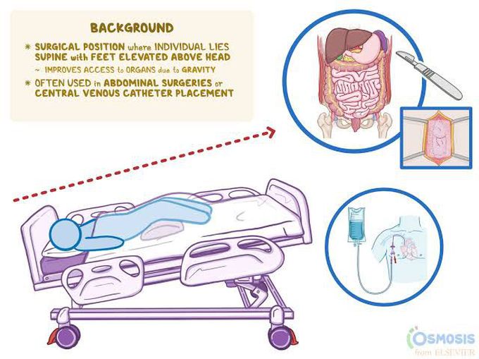 Trendelenburg position