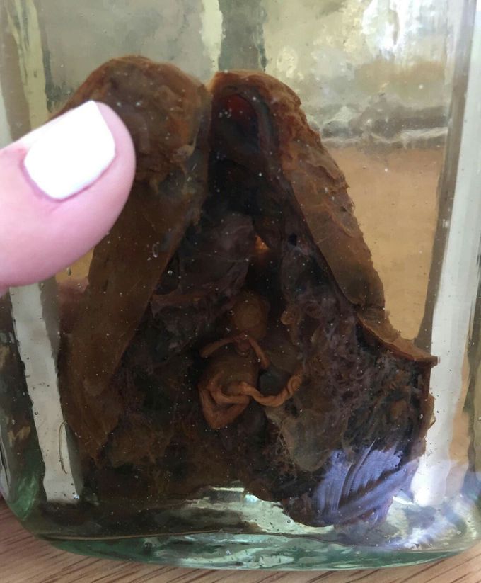 Ectopic pregnancy