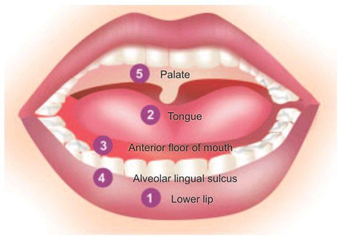 Frequency of occurrence of squamous cell carcinomas in the oral cavity.