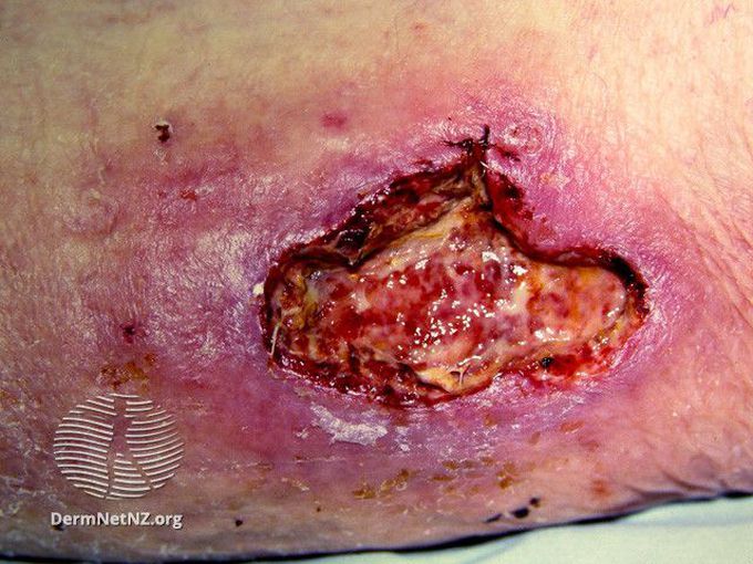 Pyoderma Gangrenosum