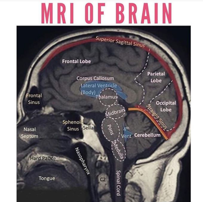 MRI with the map of the brain