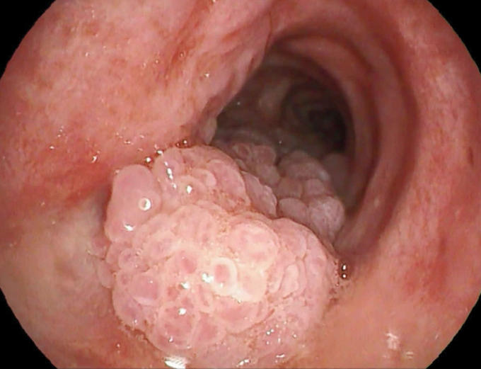 Respiratory Papillomatosis