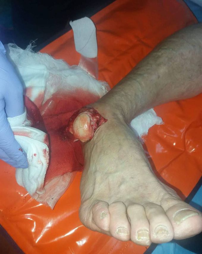 Open ankle dislocation