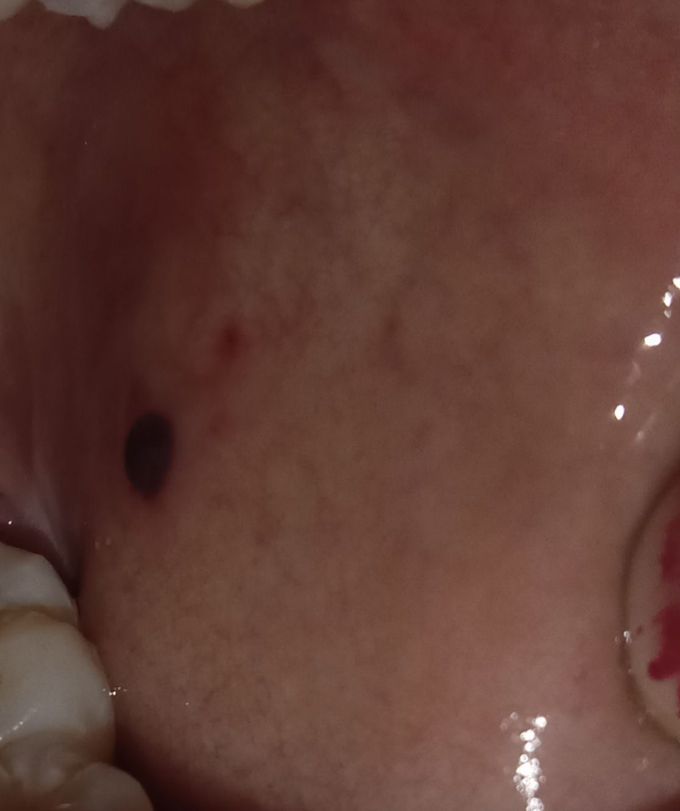 small black dot in mouth near tooth