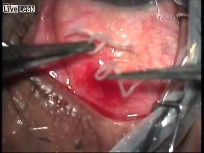 Removing A 19 CM Long Worm From Mans Eye