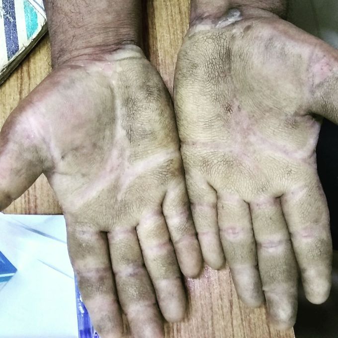 Congenital Palmar Hyperkeratosis