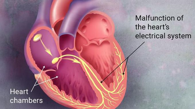 Arrhythmia