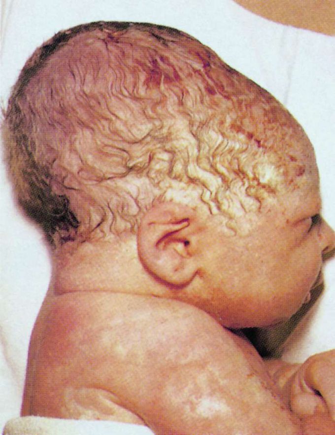 Caput succeudaneum