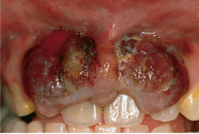 Advanced Kaposi sarcoma of gingiva