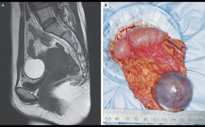 Omental Endometriosis