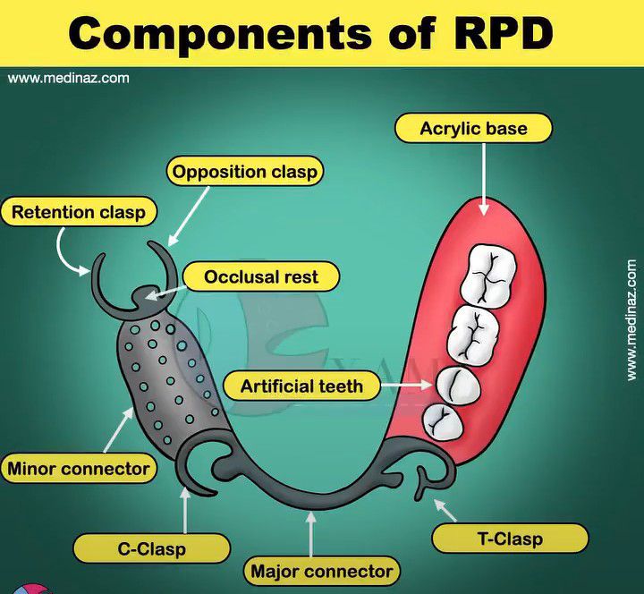 Components Of Removable Partial Denture Slideshare - Design Talk