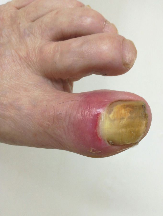 Diagnosis ?