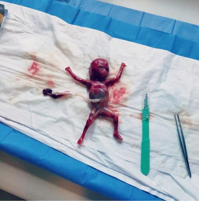 A Fetus