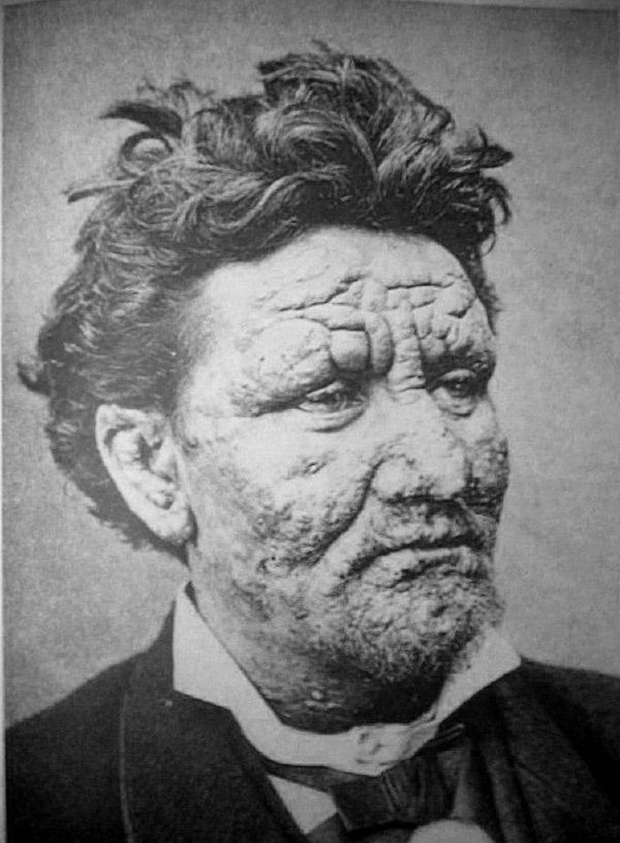 Leprosy or Hansen’s disease