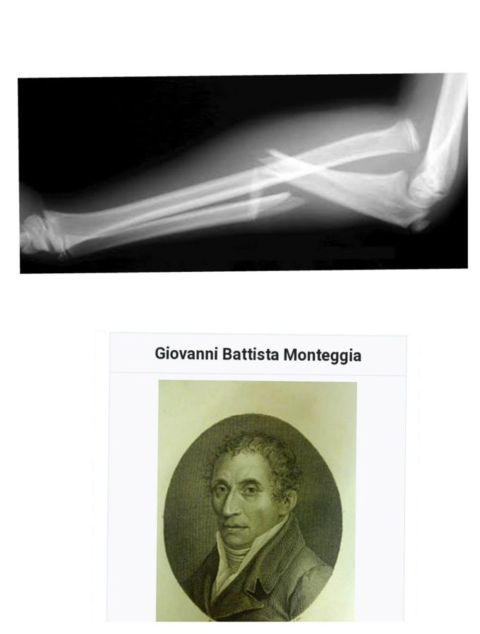 Monteggia fracture