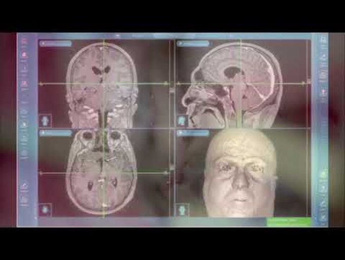 Thalamomesencephalic cavernoma: anterior transcallosal transchoroidal approach