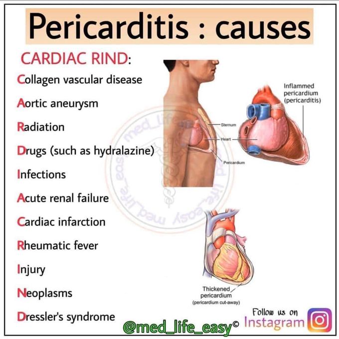 Pericarditis